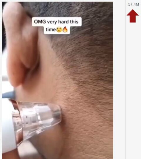 Facebook video of a man removing a mole on his neck